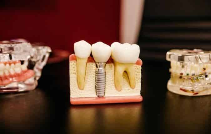 Dental Implant at Sloan Creek Dental