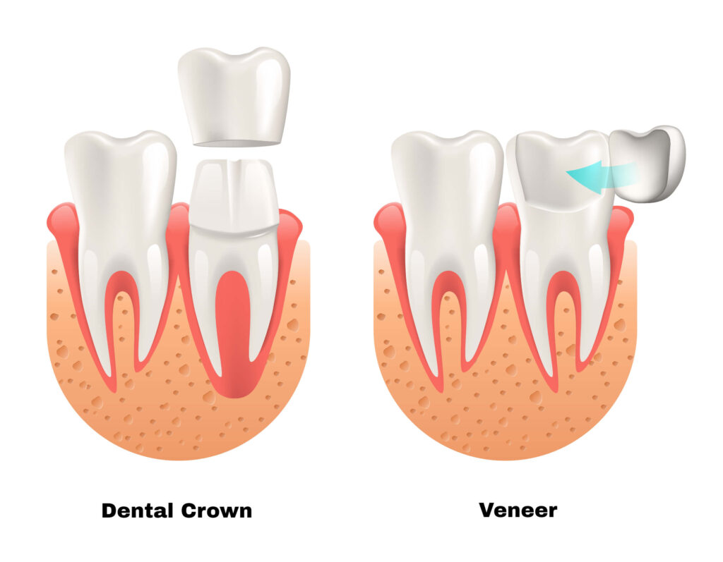 Dental Crown vs Veneer