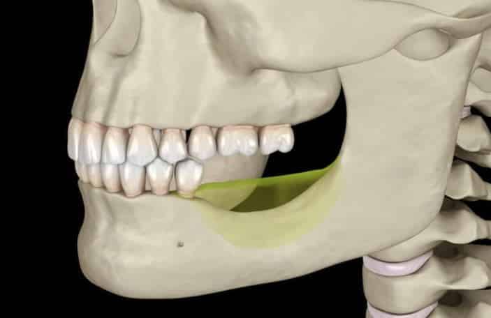 Jawbone deteriorating