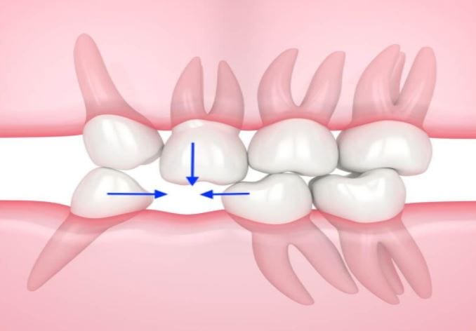 Teeth missing may result result in teeth moving