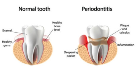 Normal tooth vs Periodontitis