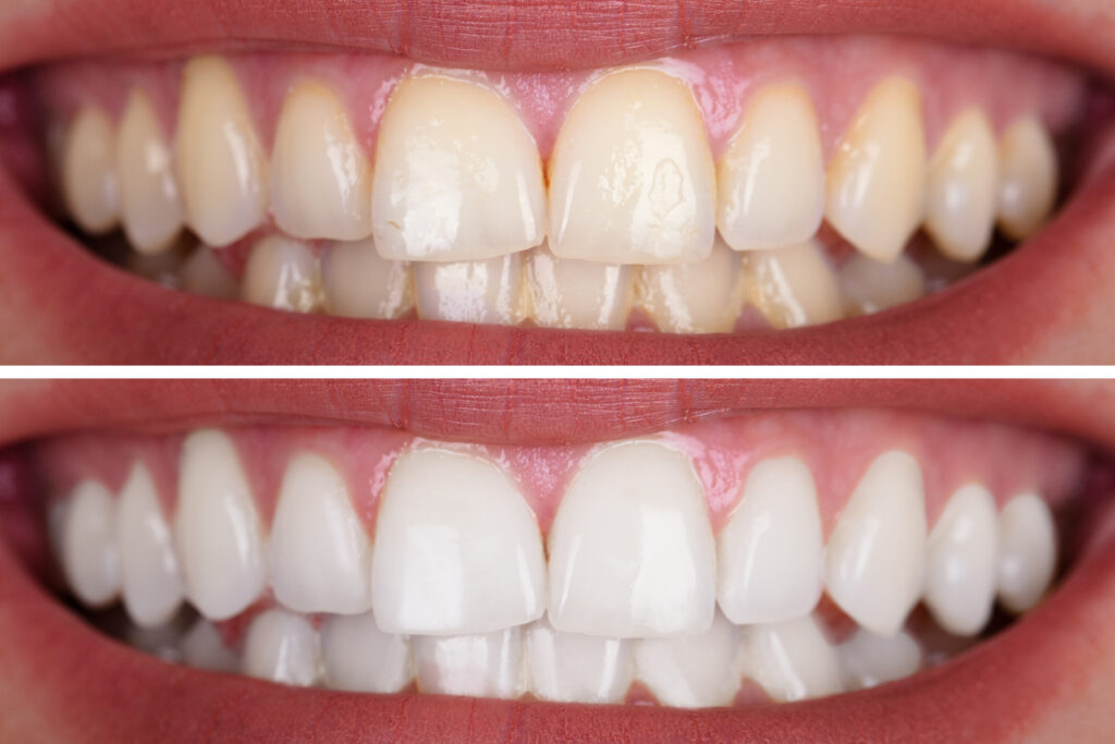 Fotona Laser Teeth Whitening