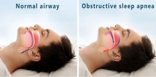 Obstructive Sleep Apnea Airway