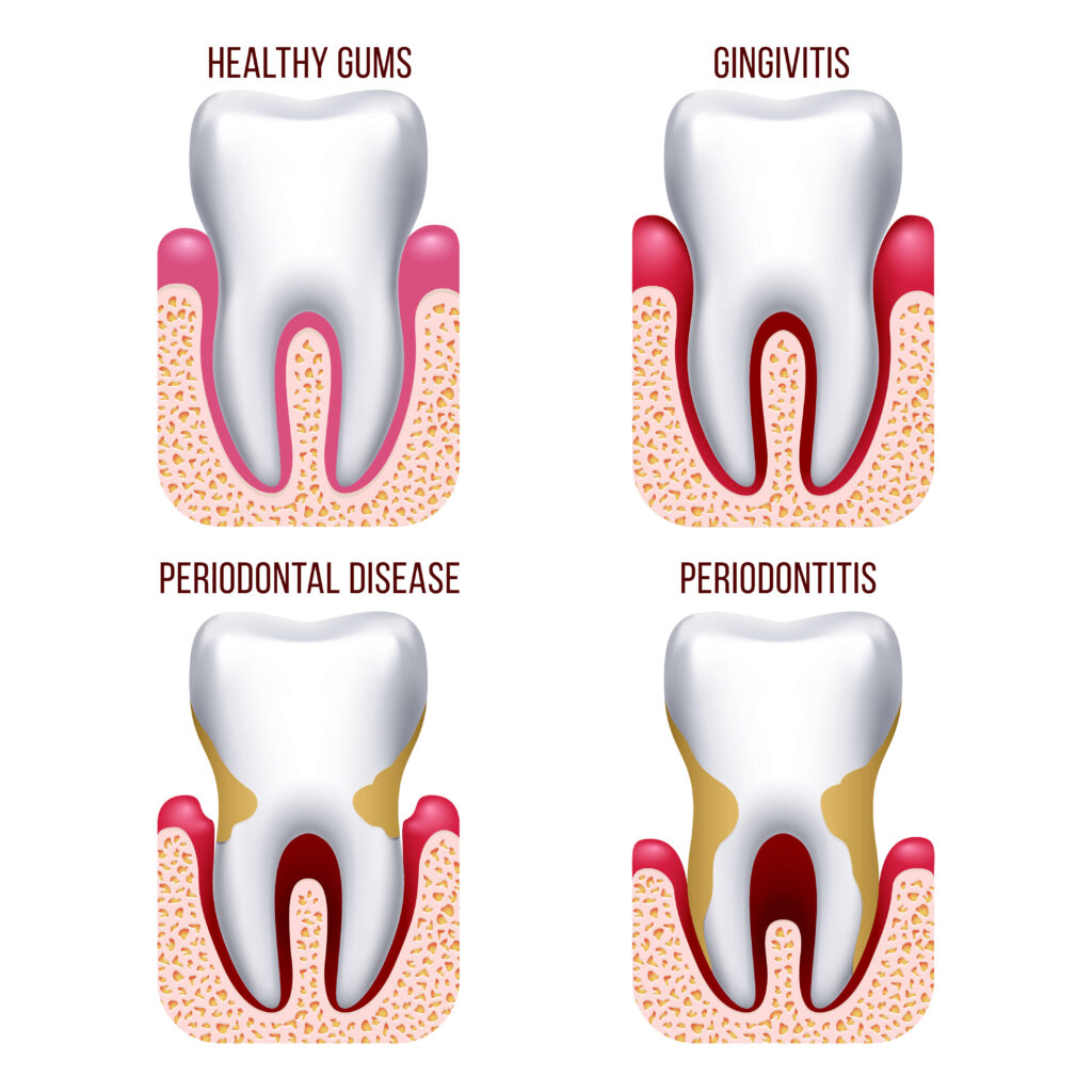 Stages of periodontal gum disease - Fairview Dentist - Sloan Creek Dental