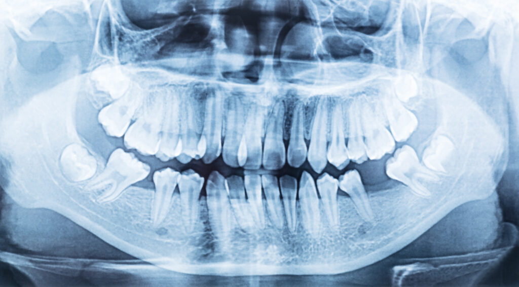 Panoramic dental x ray