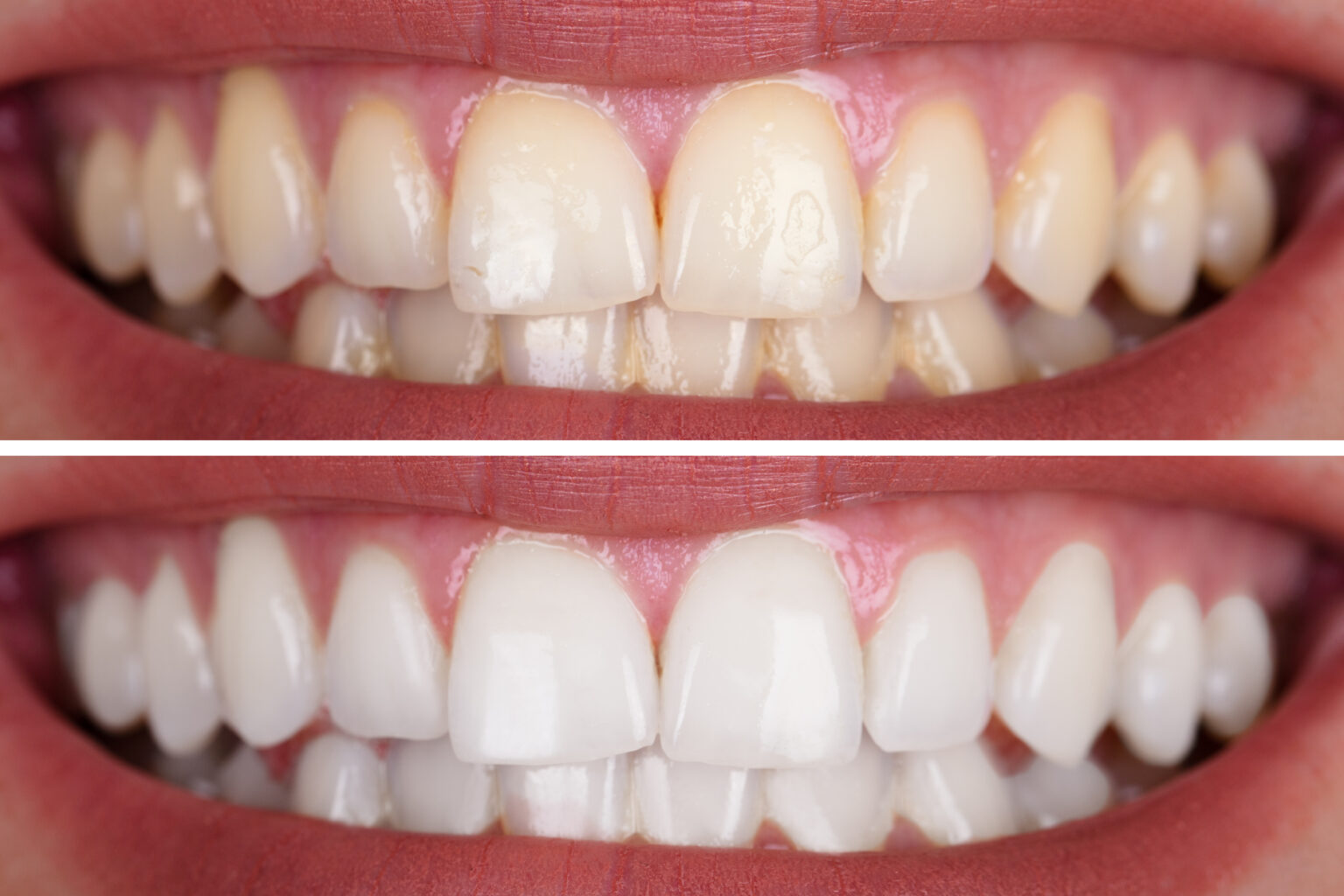 Teeth whitening laser or trays